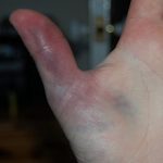 Как отличить ушиб от перелома пальца руки?