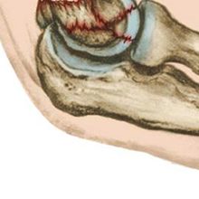 Трещина в локтевом суставе: симптомы, диагностика и лечение
